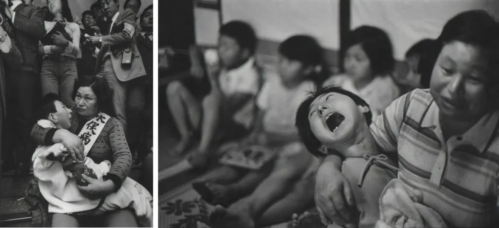 10. bambini di minimata nati con malformazioni congenite.Foto W.E.Smith
